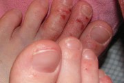 7357Aprender a vivir con dermatitis