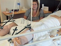Reimplantan los dos pies a un niño de diez años
