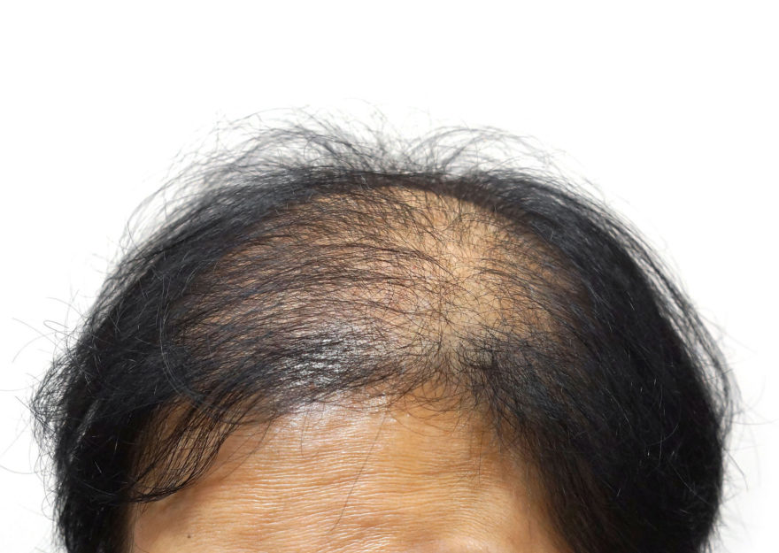61983902 Asian Female Head With Hair Loss
