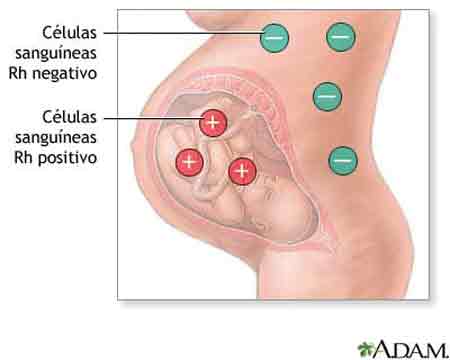 Sangre incompatible, enfermedad Rh
