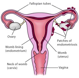 Le recomiendan un embarazo para curar una endometriosis