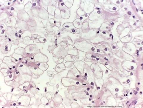 Relacionan la maternidad temprana y tener muchos hijos con cáncer de riñón