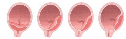 Complicaciones del parto: Placenta previa