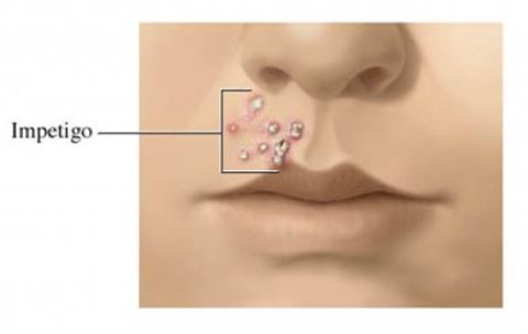 Impétigo, una infección de la piel