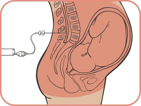 La anestesia no afecta al cerebro de los bebés nacidos por cesárea