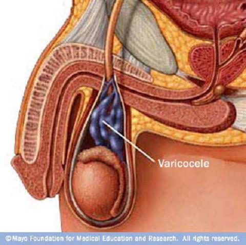 Infertilidad masculina: Varicocele