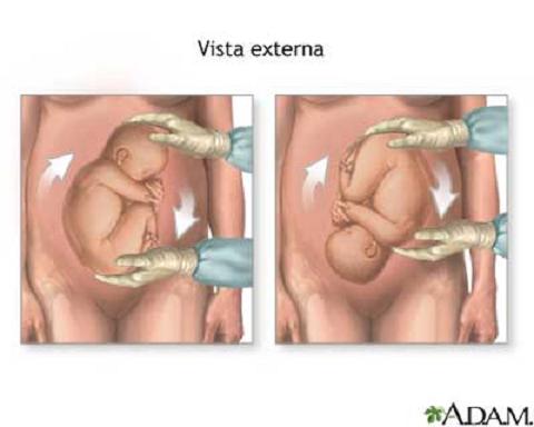 Técnicas para girar al bebé que viene de nalgas