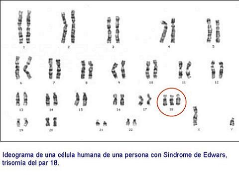 Síndrome de Edwards (trisomía 18)