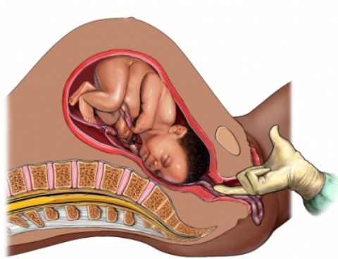 Prolapso del cordón umbilical