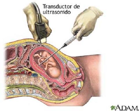 Cordocentesis: Punción del cordón umbilical durante el embarazo