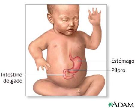 Estenosis hipertrófica de píloro o los vómitos incontrolados del bebé