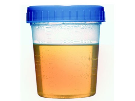 Proteinuria durante el embarazo