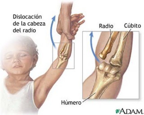 Codo de niñera o Subluxación de la cabeza del radio