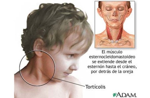 Tortícolis congénita