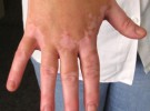 El vitiligo en los niños