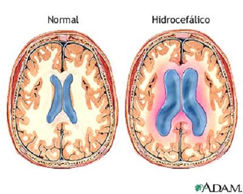 El bebé de la cabeza descomunal tiene una hidrocefalia no tratada