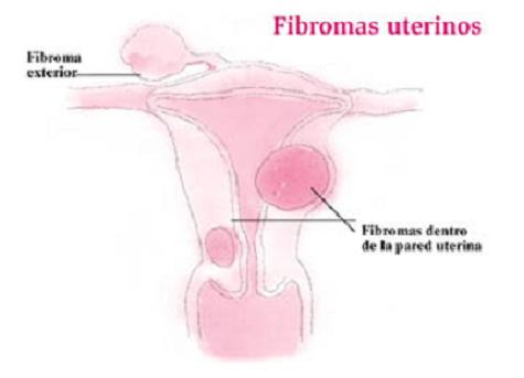 Las víctimas de abuso infantil son más propensas a tener fibromas uterinos