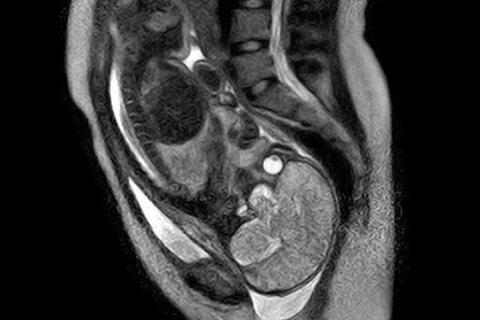 El parto ha podido ser visto en una resonancia magnética