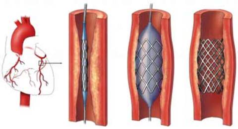 Se recupera el bebé al que se le ha implantado un soporte metálico coronario