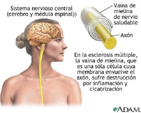 Nuevas evidencias de que el embarazo es compatible con la esclerosis múltiple