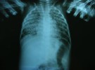 Las radiografías para confirmar el asma no deben ser rutinarias