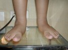 Mayor frecuencia de pies planos en niños con sobrepeso