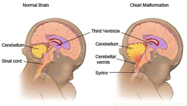 Malformación de Arnold Chiari