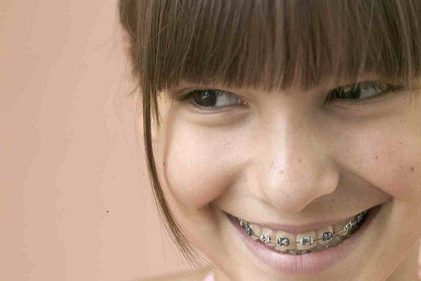 Los niños que respiran por la boca pueden tener problemas dentales