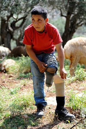 Los niños con prótesis serán de los más afectados por la ley de copago