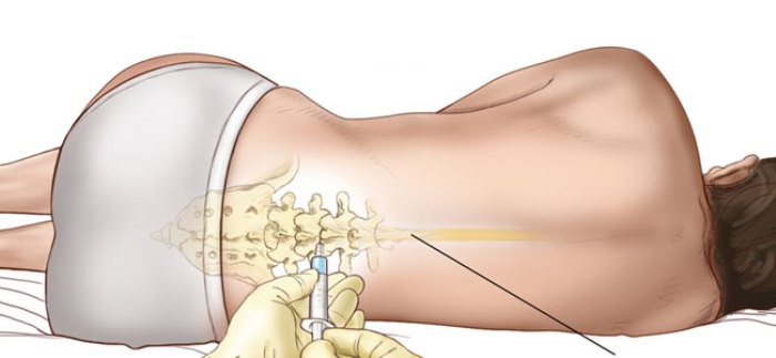 La epidural en el parto podría dañar la salud del bebé