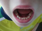 Doble fila de dientes: una anomalía que suele resolverse sin intervención