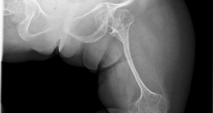 Enfermedades genéticas: Osteogénesis Imperfecta