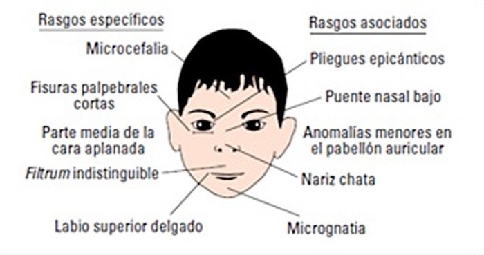 rasgos sindrome alcoholico fetal