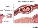 Nueva técnica para detectar los embarazos ectópicos