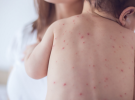 La varicela en los niños ¿qué es y cómo tratarla?