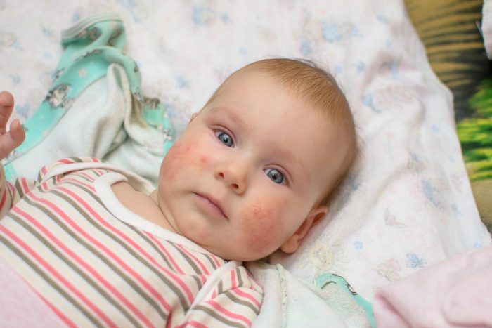 beautiful baby allergic rash on the cheeks white background