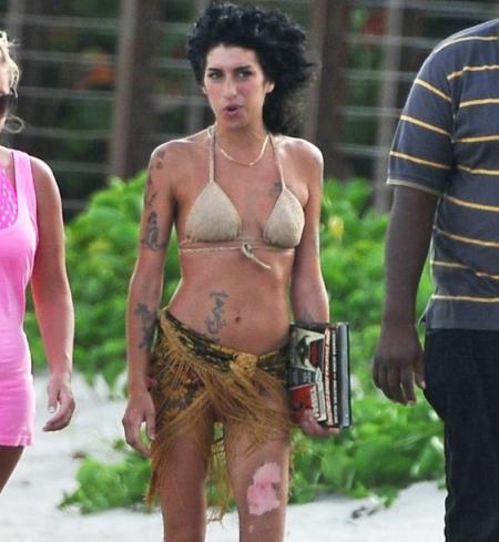 Amy Winehouse y la quemadura en la pierna