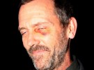 Hugh Laurie (House) causa un enorme revuelo en Londres por su ojo morado