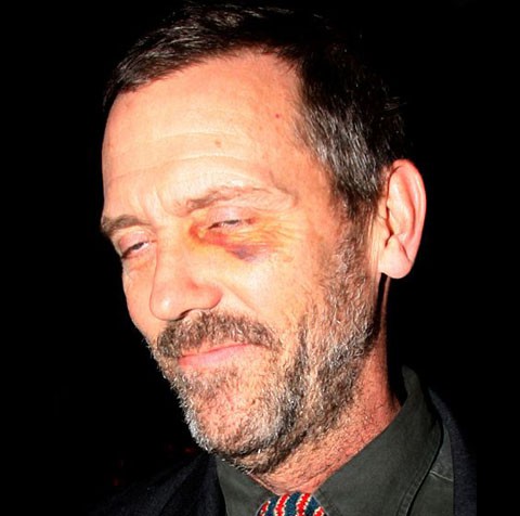 Hugh Laurie (House) causa un enorme revuelo en Londres por su ojo morado