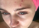 Miley Cyrus muestra sus heridas tras el ataque de un gato