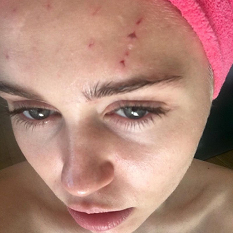 Miley Cyrus muestra sus heridas tras el ataque de un gato