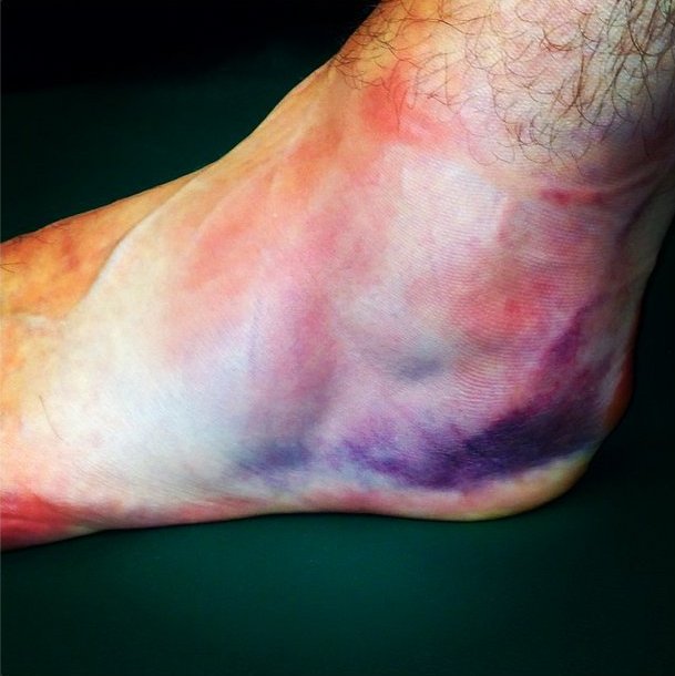 Jack White no cancela su gira a pesar de su lesión en el tobillo