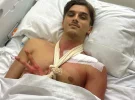 Luca Marini operado con éxito de su fractura de clavícula