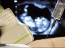 Nueva prueba para evitar la amniocentesis