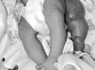 Nace un bebé con tres piernas en Perú