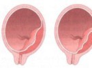 Complicaciones del parto: Placenta previa