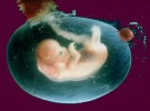 Complicaciones del embarazo: Oligohidramnios, falta de líquido amniótico