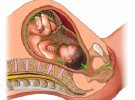 Complicaciones del embarazo: Polihidramnios, exceso de líquido amniótico