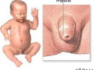 Fimosis y circuncisión del bebé