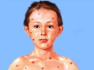 Enfermedades infantiles: El sarampión